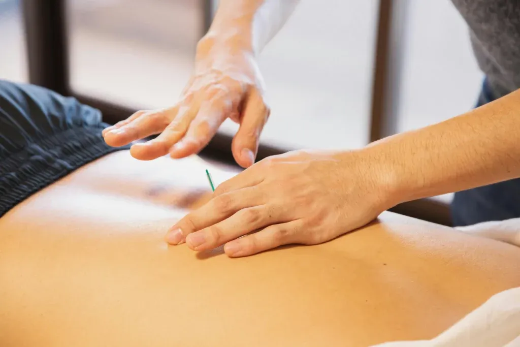 Acupuncture treatment at Limitless Spine & Joint Care in Morganville, NJ.