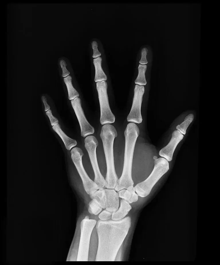 X-ray of a hand showing bones from the wrist to the fingertips, illustrating potential causes of hand and wrist pain treated at Limitless Spine & Joint Care.