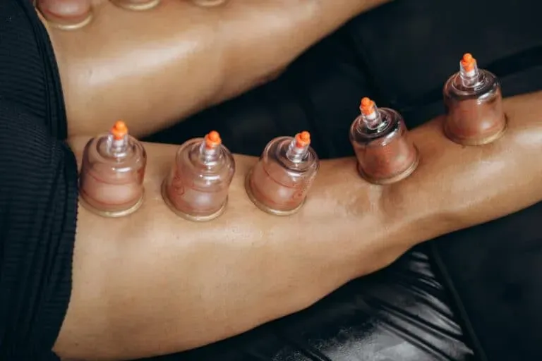 Cupping therapy on a patient's leg, with several glass cups creating suction. Limitless Healthcare Team at Limitless Spine & Joint Care may use this for sports injuries.