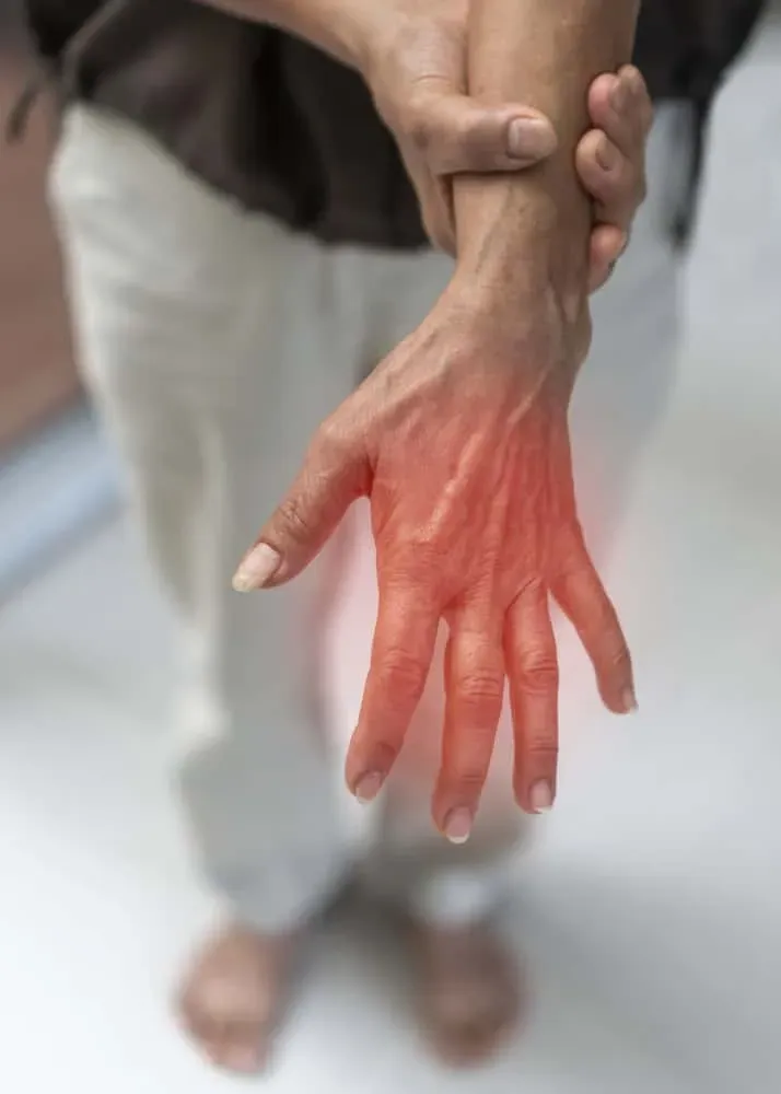 Neuropathy